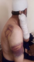 Hombre magullado con el brazo y la cabeza vendados mirando hacia otro lado de la cámara.