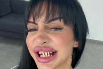 Tengo dientes de pavo, pero los trolls dicen que me arrepentiré y piensan que son demasiado brillantes.