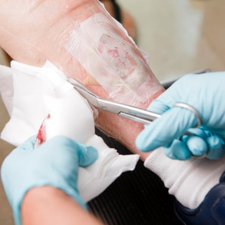 Un cambio de vendaje en un absceso en la pierna.  Paciente sometido a terapia con gusanos para desbridar la herida.  Se introducen varios cientos de gusanos estériles en la herida, que se sujetan con un vendaje adhesivo, para eliminar el tejido muerto.
