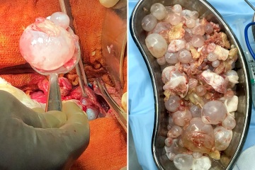 Impresionante momento en que los médicos eliminan 759 quistes del estómago de una mujer