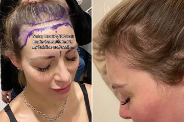 Odiaba mi frente, así que tuve un trasplante de cabello que me costó más de £ 1 por cabello