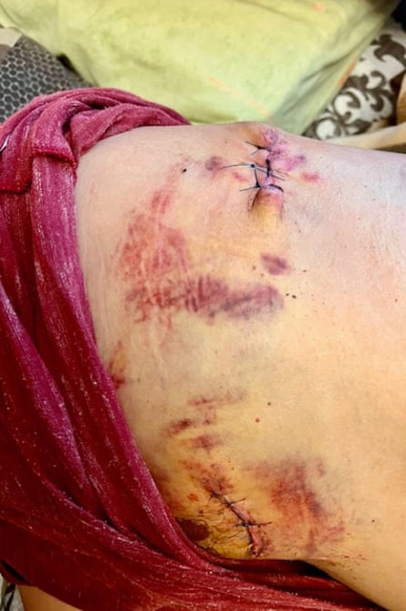Pierna magullada con heridas cosidas.