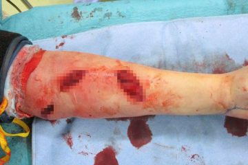 Las mordeduras de serpiente dejaron a 2 hombres en agonía cuando sus músculos explotaron desde adentro